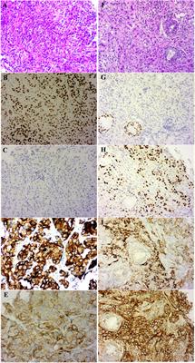 Case Report: A Case Report of a Histological Transformation of ALK-Rearranged Adenocarcinoma With High Expression of PD-L1 to Squamous Cell Carcinoma After Treatment With Alectinib